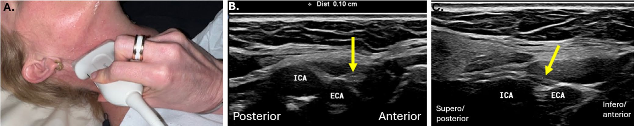 Posición del transductor y ecografías del cambio entre los segmentos horizontal y vertical del nervio hipogloso